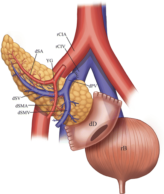 Get Pancreas Transplant in Pune