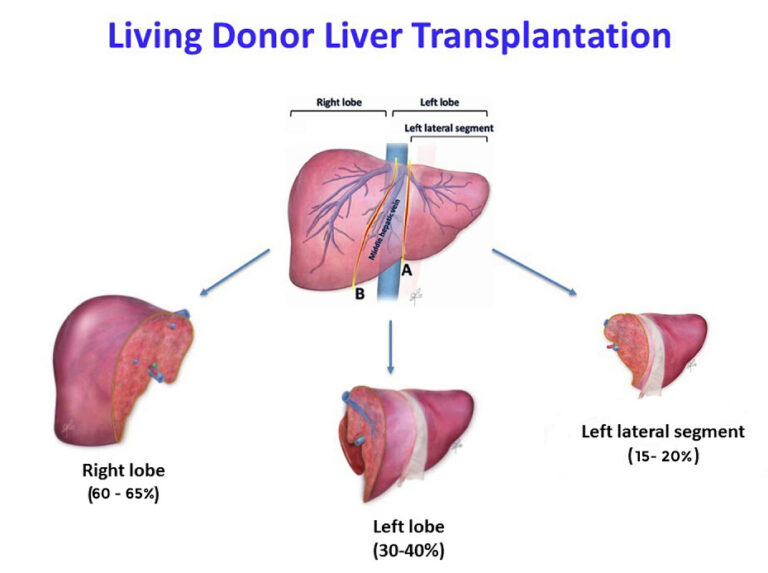 Home Living donor Liver Transplant in Pune