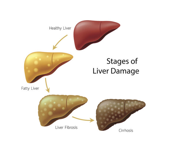 What Cause Liver Failure